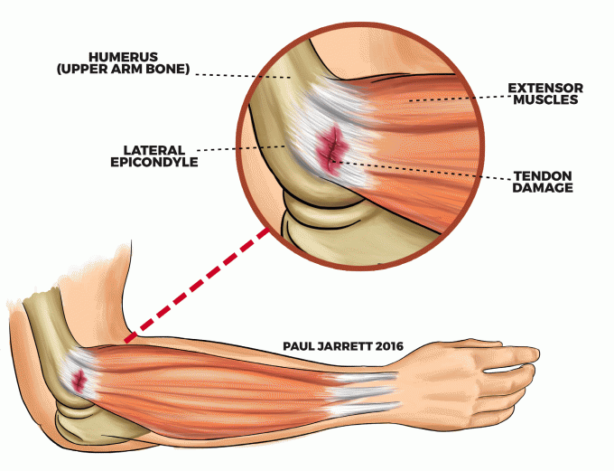 BS-SWT2Xの物理療法の衝撃波ESWTの痛みの軽減の衝撃波機械療法の柔らかいティッシュの傷