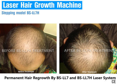 毛損失のための毛の若返り療法の痛みのないダイオード レーザーの毛の再生装置