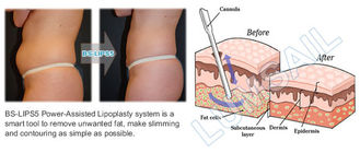 3 1台の外科真空の脂肪吸引術のキャビテーション機械/脂肪質の減少装置で