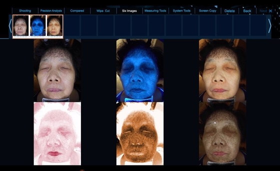 6スペクトルはより明確な皮問題の顔の皮の分析装置を見ます