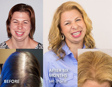 Diode Laser Hair Regrowth Device Handheld Probe Hair Growing Machine For Hair Salon