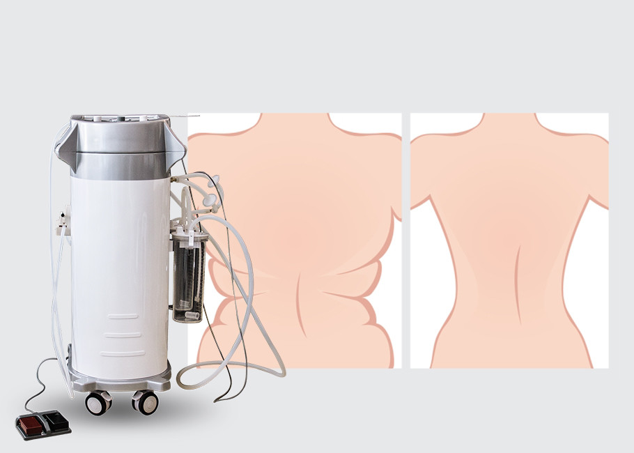 300W Input Power Surgical Liposuction Machine Lipo Slim Machine 2000ml Capacity Storage Bottle